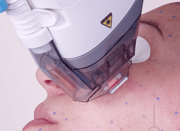 Fraxel treatment
