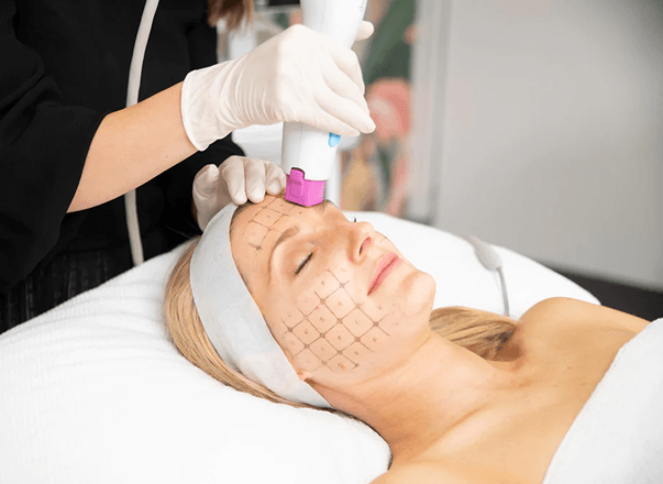 Thermage treatment